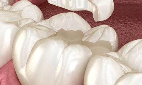 composite-dental-filling